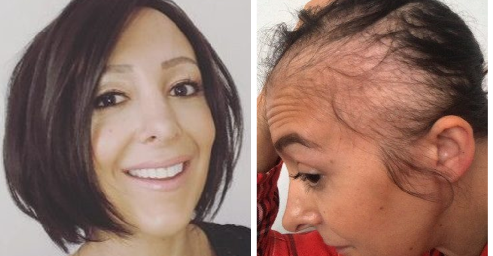 El drama de la mujer que perdió por completo su cabello tras dar a luz a su segundo hijo