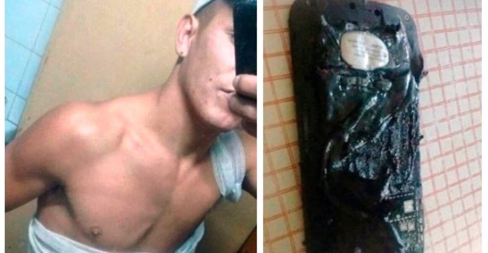 «Sufrí ampollas desde las piernas hasta las axilas” – Su teléfono móvil explotó mientras dormía