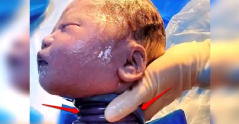 El cordón de un bebé daba 6 vueltas alrededor de su cuello y hacen un parto natural