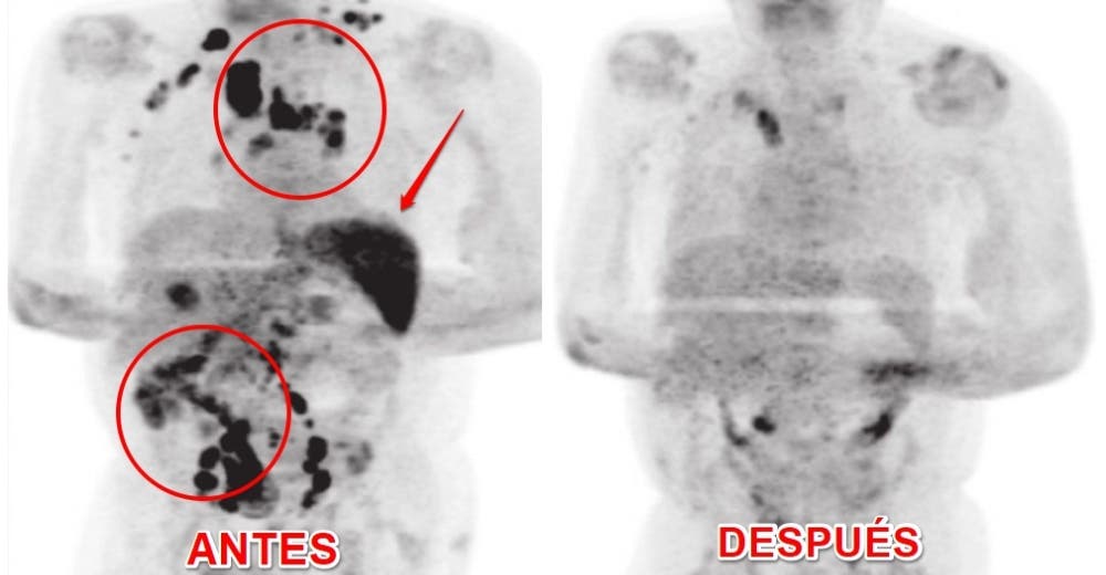 Informan que un paciente se cura del cáncer tras padecer COVID-19