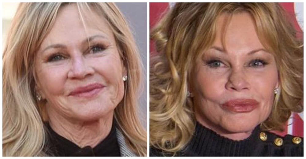 El impactante nuevo rostro de Melanie Griffith tras los «exagerados» retoques